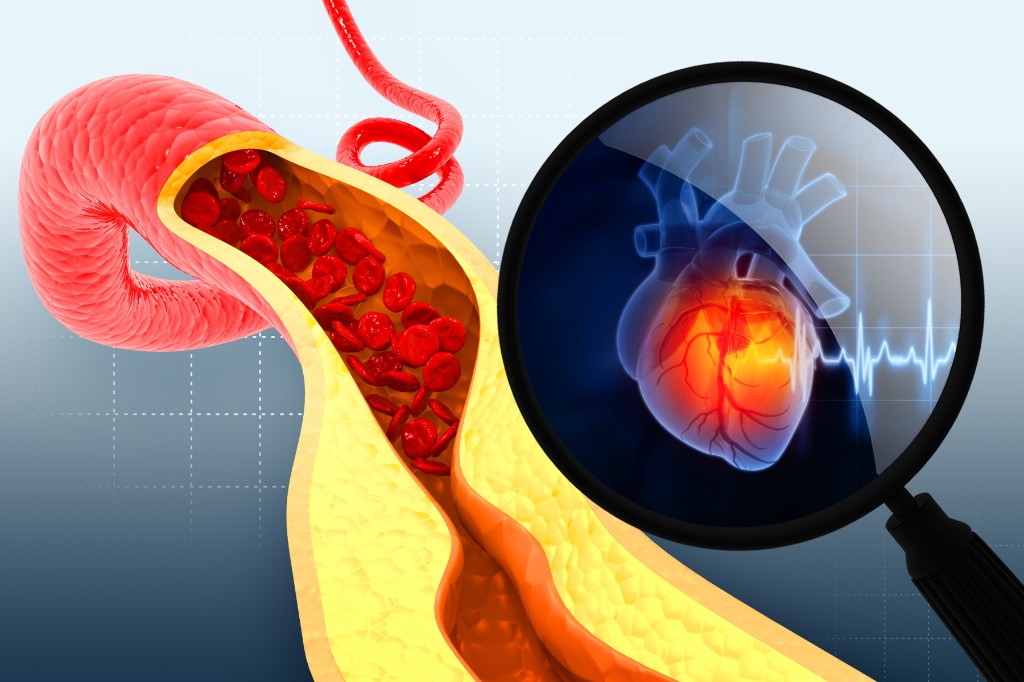 Aterosclerosis