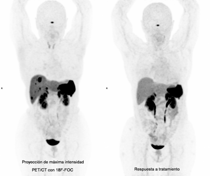Proyección de máxima intensidad PET/CT con 18F-FOC y respuesta a tratamiento