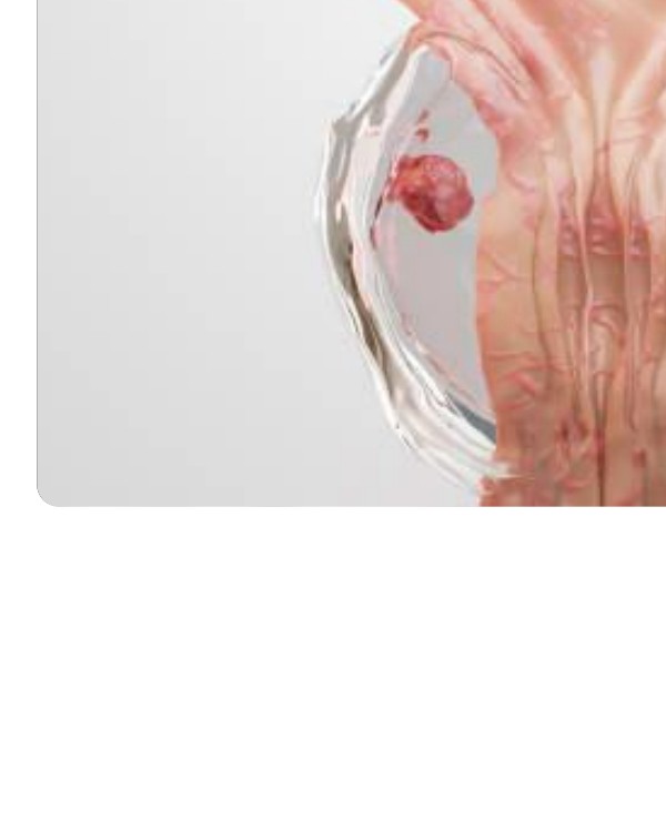 Ilustración de tumor en próstata